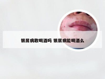 银屑病敢喝酒吗 银屑病能喝酒么