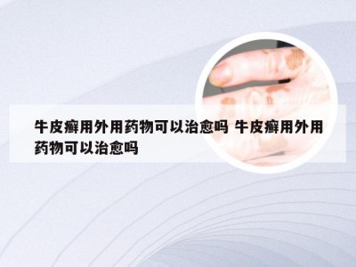 牛皮癣用外用药物可以治愈吗 牛皮癣用外用药物可以治愈吗