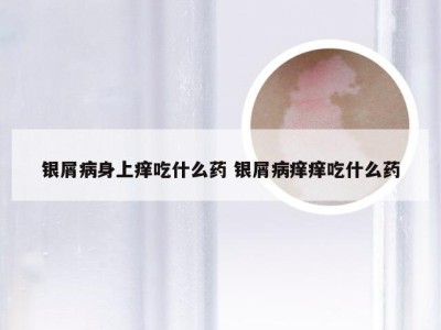 银屑病身上痒吃什么药 银屑病痒痒吃什么药
