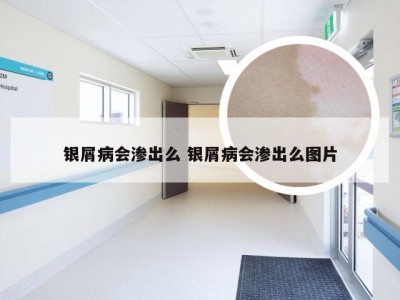 银屑病会渗出么 银屑病会渗出么图片