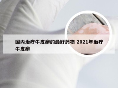 国内治疗牛皮癣的最好药物 2021年治疗牛皮癣