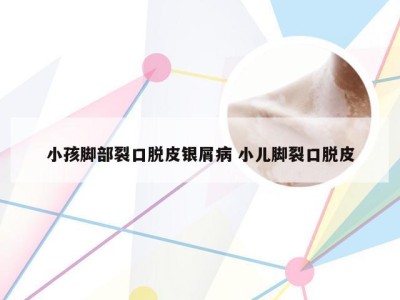 小孩脚部裂口脱皮银屑病 小儿脚裂口脱皮