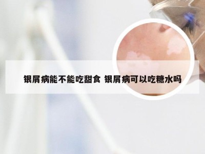 银屑病能不能吃甜食 银屑病可以吃糖水吗
