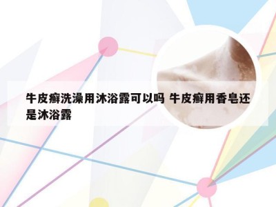 牛皮癣洗澡用沐浴露可以吗 牛皮癣用香皂还是沐浴露