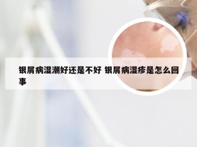 银屑病湿潮好还是不好 银屑病湿疹是怎么回事