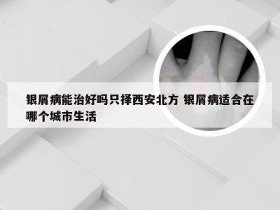 银屑病能治好吗只择西安北方 银屑病适合在哪个城市生活