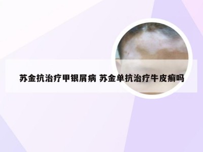 苏金抗治疗甲银屑病 苏金单抗治疗牛皮癣吗