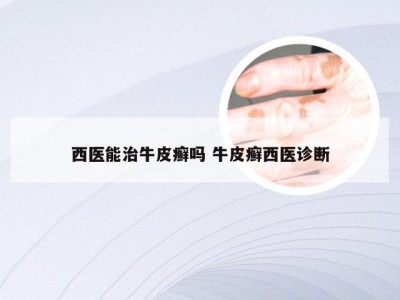 西医能治牛皮癣吗 牛皮癣西医诊断