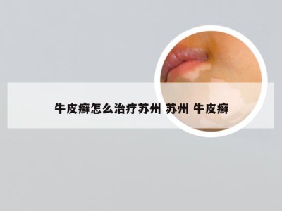 牛皮癣怎么治疗苏州 苏州 牛皮癣