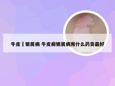 牛皮癬银屑病 牛皮癣银屑病用什么药膏最好