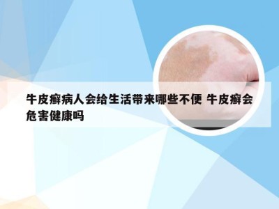 牛皮癣病人会给生活带来哪些不便 牛皮癣会危害健康吗