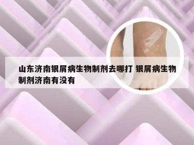 山东济南银屑病生物制剂去哪打 银屑病生物制剂济南有没有