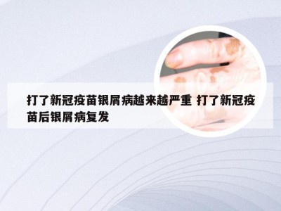 打了新冠疫苗银屑病越来越严重 打了新冠疫苗后银屑病复发