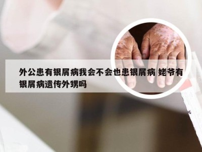 外公患有银屑病我会不会也患银屑病 姥爷有银屑病遗传外甥吗