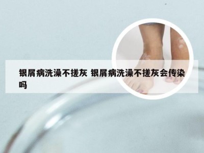 银屑病洗澡不搓灰 银屑病洗澡不搓灰会传染吗