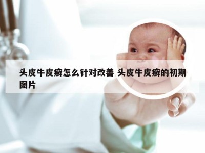 头皮牛皮癣怎么针对改善 头皮牛皮癣的初期图片