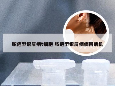 脓疱型银屑病t细胞 脓疱型银屑病病因病机