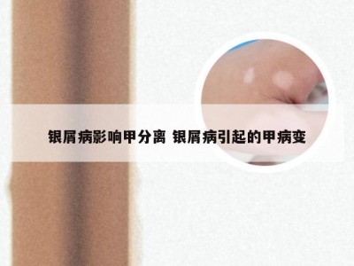 银屑病影响甲分离 银屑病引起的甲病变