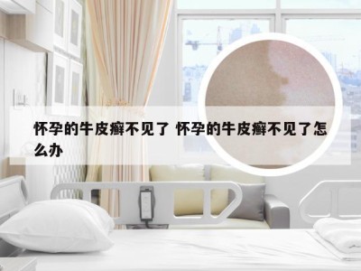 怀孕的牛皮癣不见了 怀孕的牛皮癣不见了怎么办