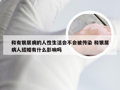 和有银屑病的人性生活会不会被传染 和银屑病人结婚有什么影响吗