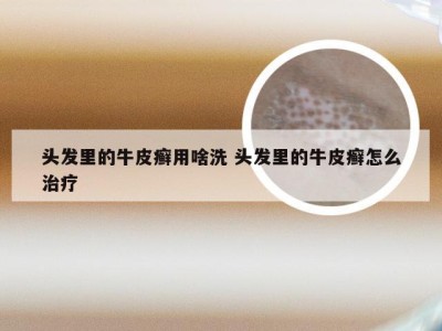 头发里的牛皮癣用啥洗 头发里的牛皮癣怎么治疗