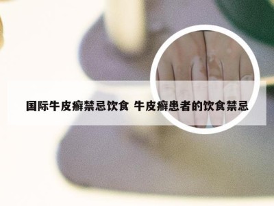 国际牛皮癣禁忌饮食 牛皮癣患者的饮食禁忌