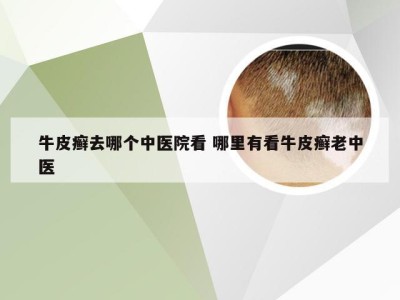 牛皮癣去哪个中医院看 哪里有看牛皮癣老中医