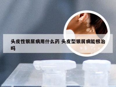 头皮性银屑病用什么药 头皮型银屑病能根治吗