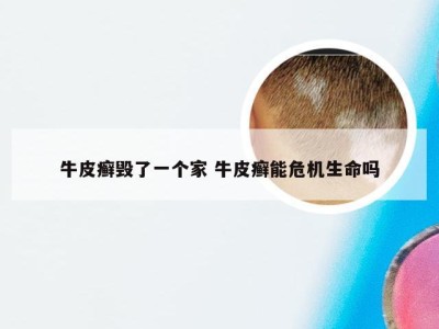 牛皮癣毁了一个家 牛皮癣能危机生命吗