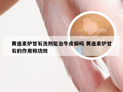 黄连素炉甘石洗剂能治牛皮癣吗 黄连素炉甘石的作用和功效