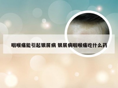 咽喉痛能引起银屑病 银屑病咽喉痛吃什么药