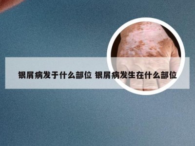 银屑病发于什么部位 银屑病发生在什么部位