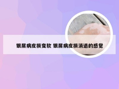 银屑病皮损变软 银屑病皮损消退的感觉