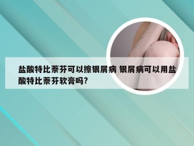 盐酸特比萘芬可以擦银屑病 银屑病可以用盐酸特比萘芬软膏吗?
