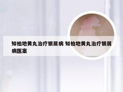 知柏地黄丸治疗银屑病 知柏地黄丸治疗银屑病医案