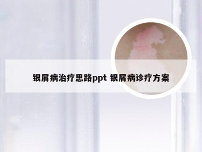 银屑病治疗思路ppt 银屑病诊疗方案