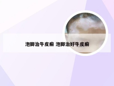 泡脚治牛皮癣 泡脚治好牛皮癣