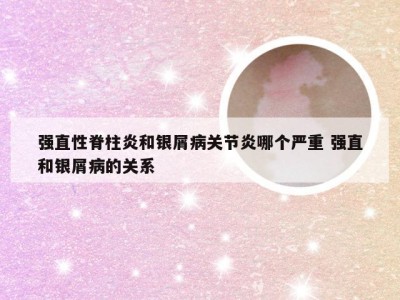 强直性脊柱炎和银屑病关节炎哪个严重 强直和银屑病的关系