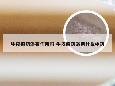 牛皮癣药浴有作用吗 牛皮癣药浴用什么中药