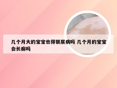 几个月大的宝宝也得银屑病吗 几个月的宝宝会长癣吗