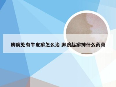 脚腕处有牛皮癣怎么治 脚腕起癣抹什么药膏