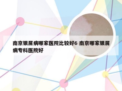 南京银屑病哪家医院比较好6 南京哪家银屑病专科医院好