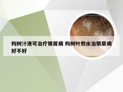 构树汁液可治疗银屑病 构树叶熬水治银屑病好不好