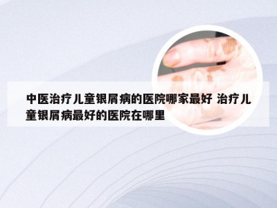 中医治疗儿童银屑病的医院哪家最好 治疗儿童银屑病最好的医院在哪里