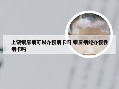 上饶银屑病可以办慢病卡吗 银屑病能办慢性病卡吗