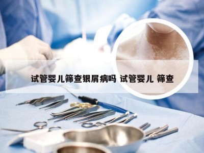 试管婴儿筛查银屑病吗 试管婴儿 筛查