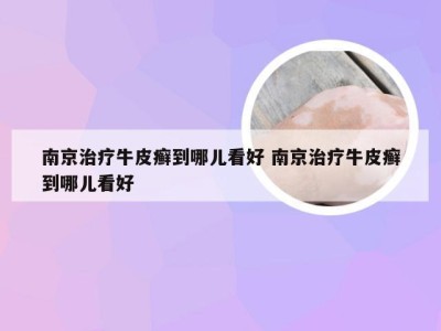 南京治疗牛皮癣到哪儿看好 南京治疗牛皮癣到哪儿看好
