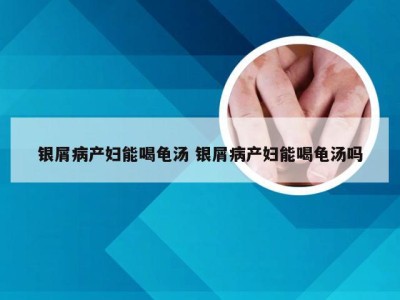 银屑病产妇能喝龟汤 银屑病产妇能喝龟汤吗