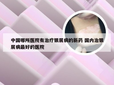 中国哪所医院有治疗银屑病的新药 国内治银屑病最好的医院
