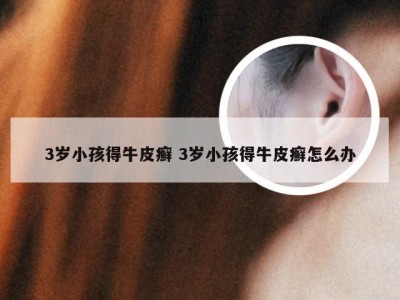 3岁小孩得牛皮癣 3岁小孩得牛皮癣怎么办